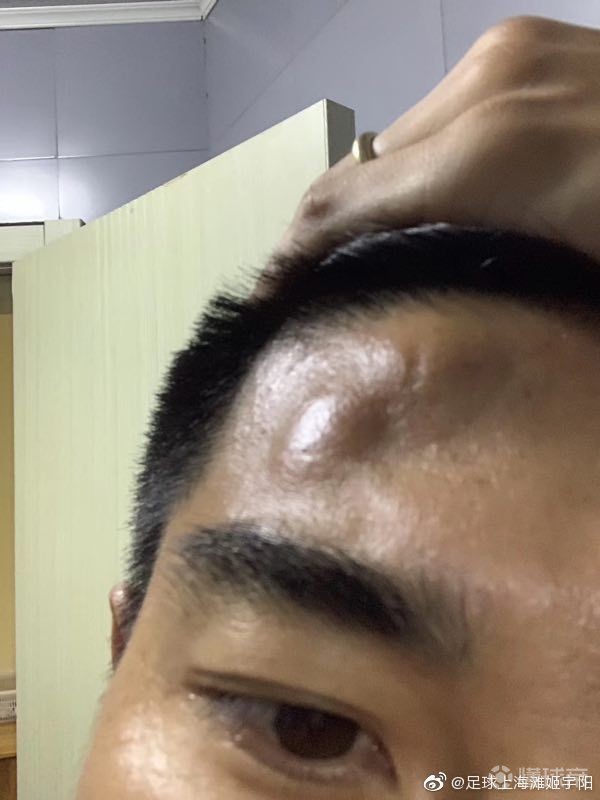 遭塞尔纳斯肘击孙世林头部肿起了一个大包