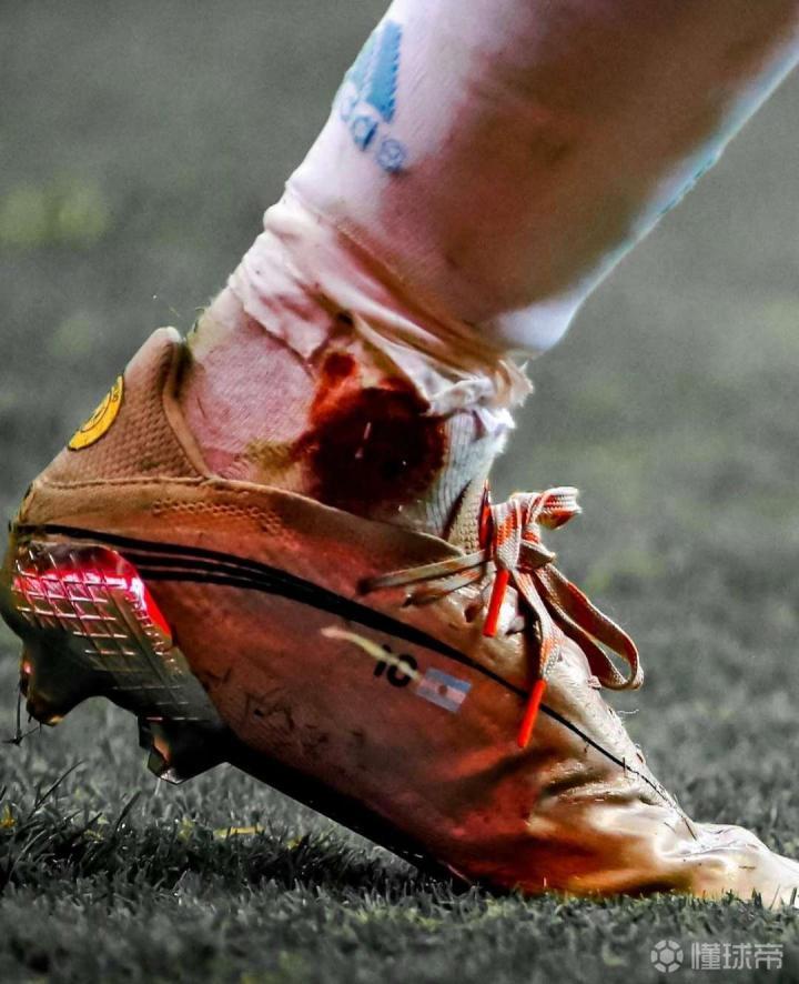 梅西受伤的脚踝!|懂球帝