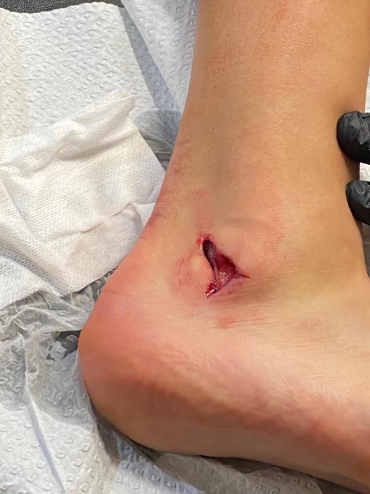 缝针图慎入!达洛特脚踝皮开肉绽,赛后紧急接受缝合治疗