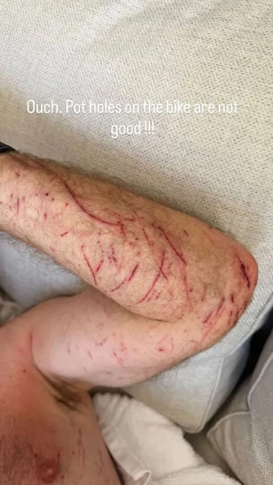 希勒骑车时因路面坑洞摔伤，手部和腿部有多处擦伤