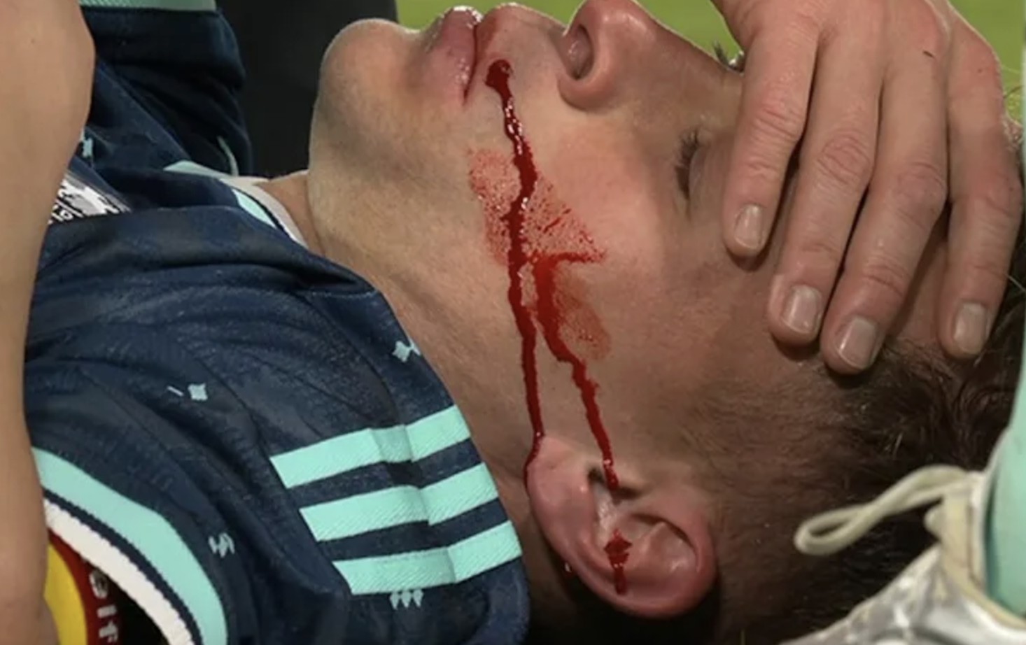 基米希在与瑞士球员争顶时被肘击、划伤面部，血流满面