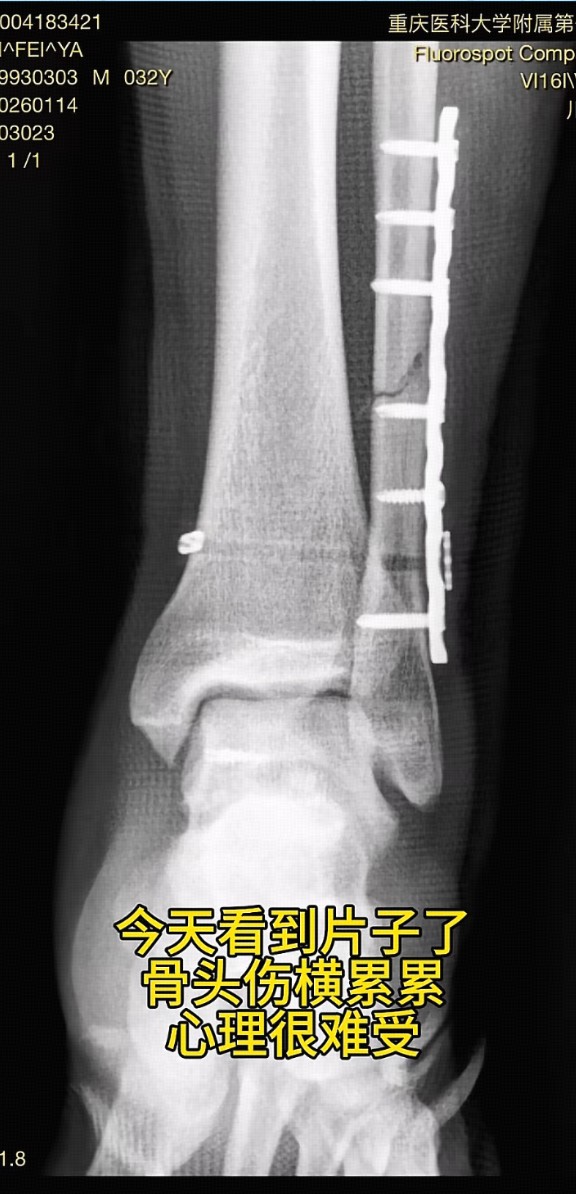 友谊切磋安全第一！渝超球员友谊赛被铲成重伤，李昊送上祝福